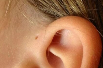 os Flip Qué es ese pequeño "hoyito" en la oreja y por qué algunas personas lo tienen
