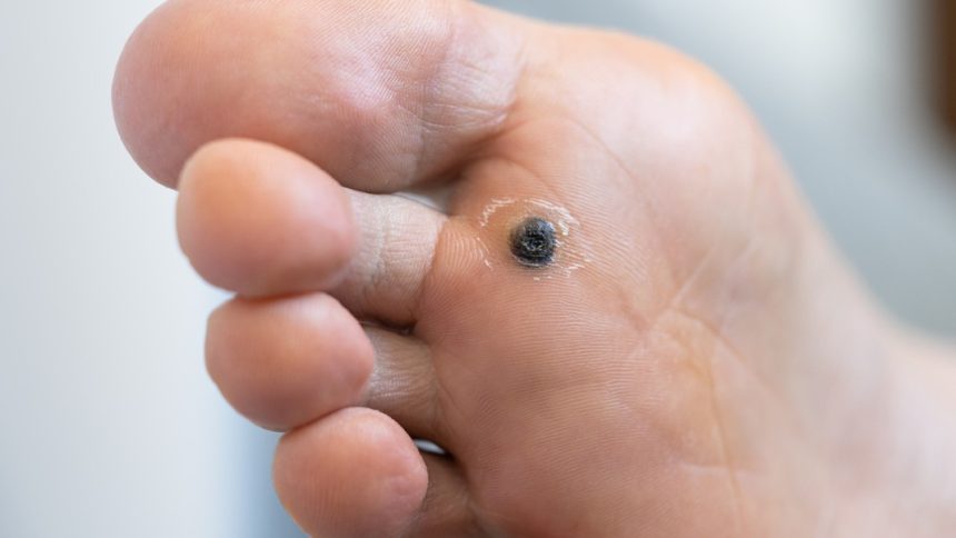 ¿Cómo reconocer una infección por molusco contagioso o VPH?