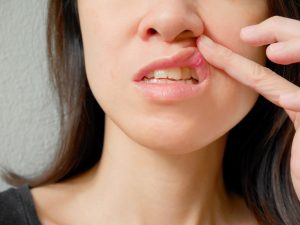 
Cómo identificar el virus del papiloma humano en la boca