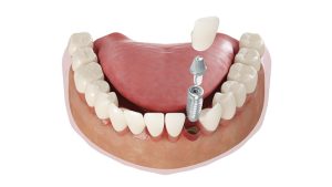 Crean medicamento para regenerar dientes: ¿el fin de las coronas e implantes?