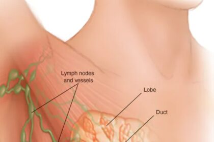Una de cada 12 mujeres en el mundo desarrollará cáncer de mama, según la OMS