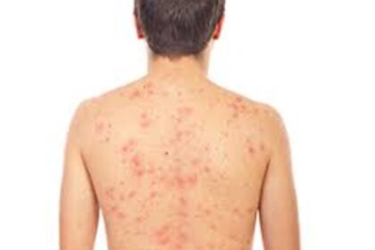 Gobierno invierte RD$222.9 millones en medicamentos alto costo para pacientes con psoriasis