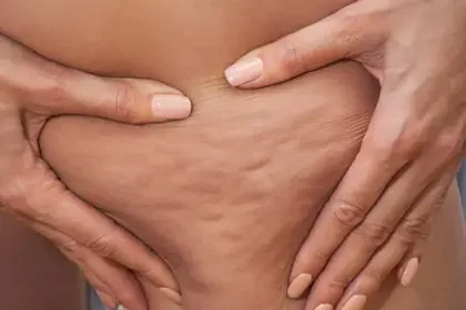 Qué es la celulitis: olvídate de la temible 'piel de naranja'