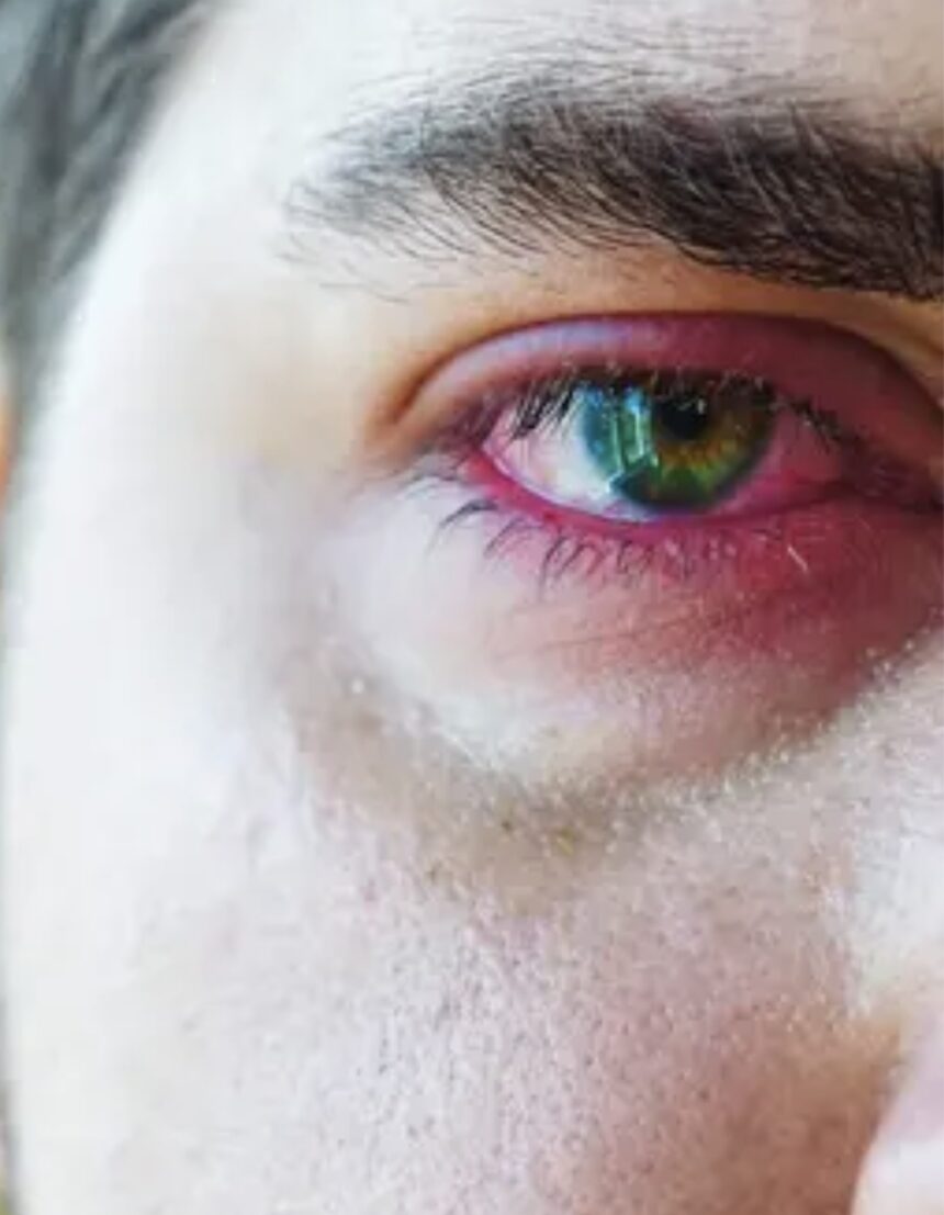 ¿Qué es una infección ocular? Así perdió la vista Elton John