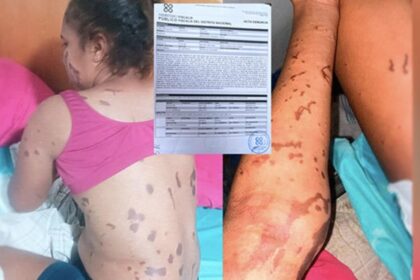 Fuera de Serie :Mujer y su hija sufren graves quemaduras tras ataque con «ácido del diablo»
