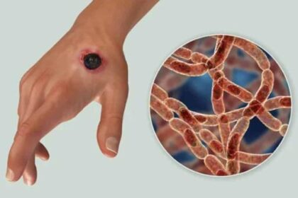 ¿Qué es el ántrax? La enfermedad que genera preocupación ante sospechas de casos en Haití